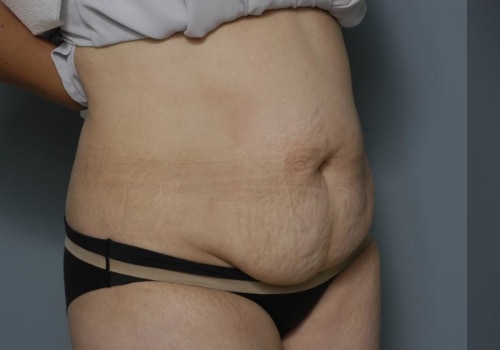 Tummy Tucks for Plus-Size Patients: What You Need to Know